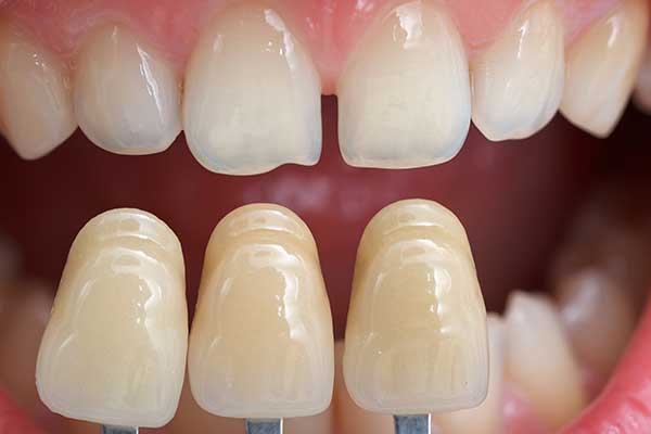 Tooth Shade Guide for Cosmetic Bonding 