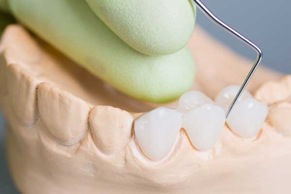 Model of Porcelain Dental Bridge