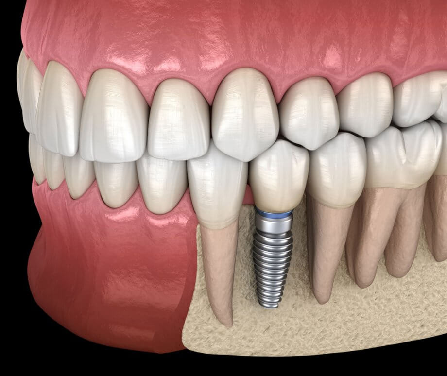 illustration depicts dental implant