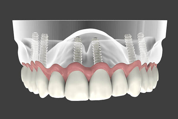 Graphic Showing Dental Implant Supported Dentures 