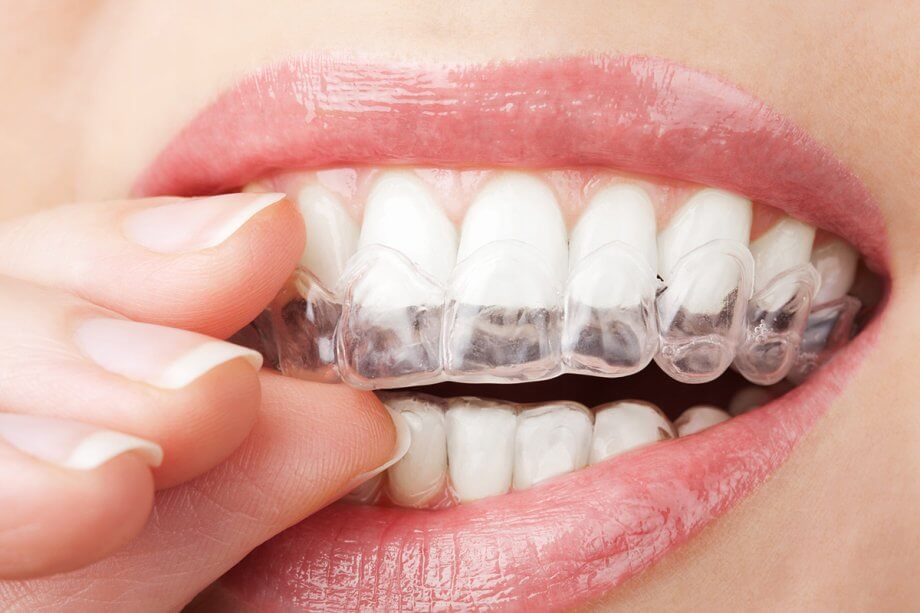 Invisalign