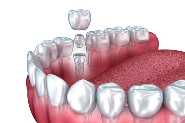 Illustration Of Dental Implant 