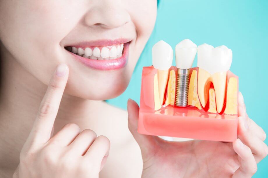 Bella Dental Implants - Myths vs. Facts