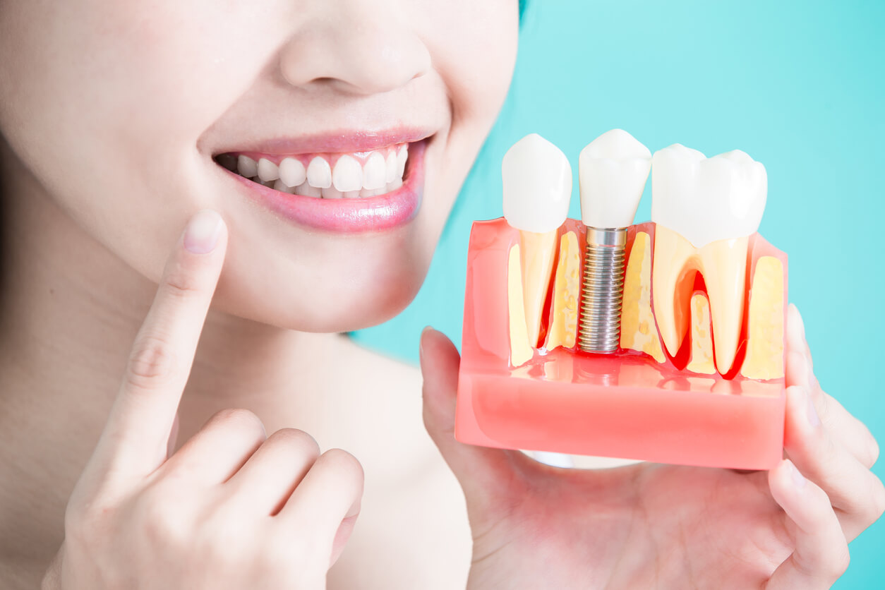 Dental Implants Myths vs. Facts Bella Dental NJ
