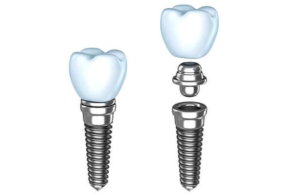 Graphic Showing Single Tooth Dental Implants