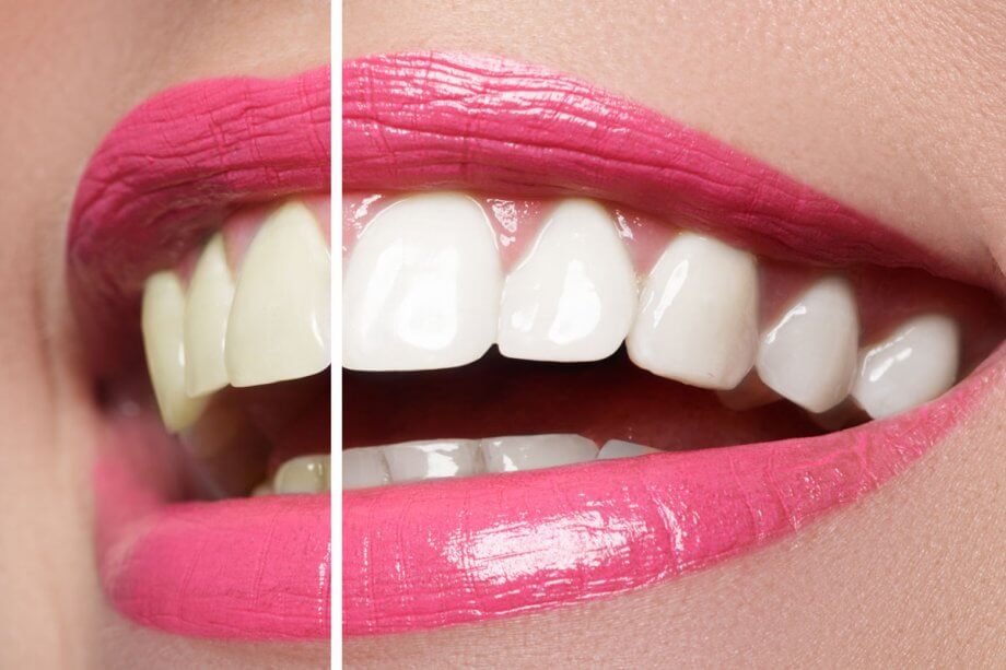 split photo shows shades of teeth before and after teeth whitening