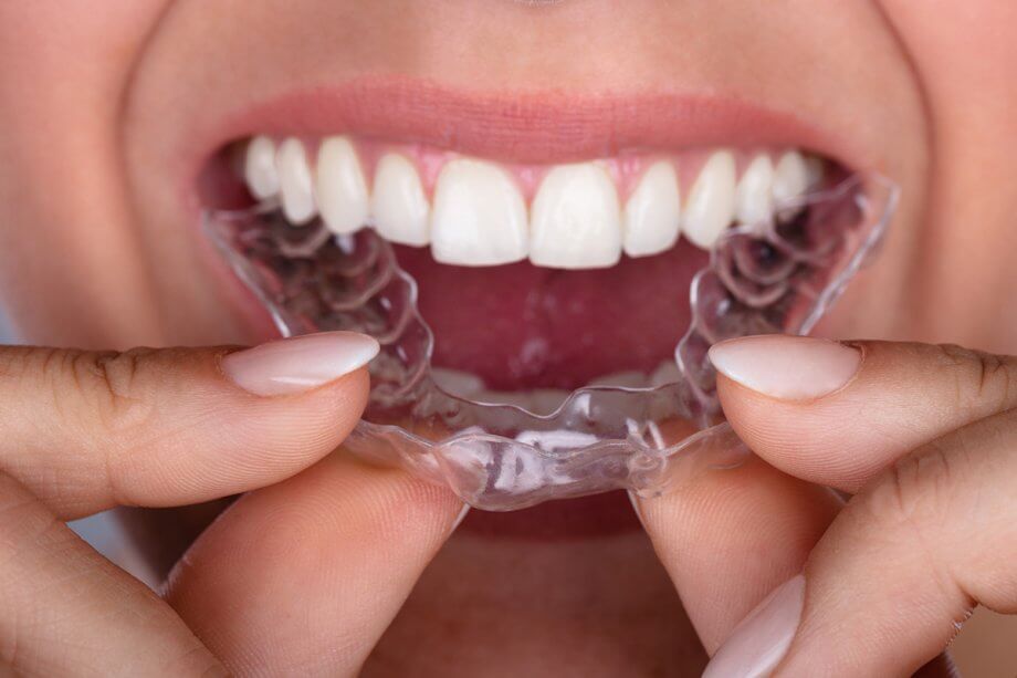 Does Invisalign Really Work?