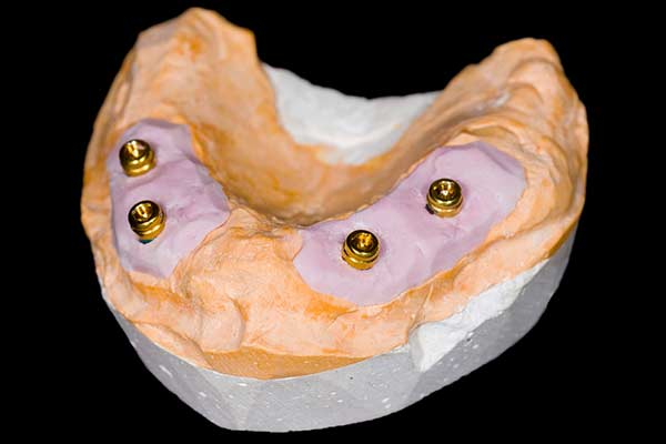 Model Showing Full Arch with Only Four Dental Implants