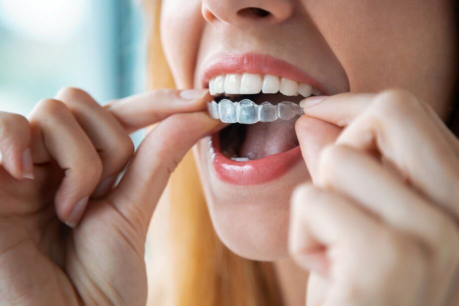 How Much Is Invisalign Without Insurance in Monmouth County, NJ?