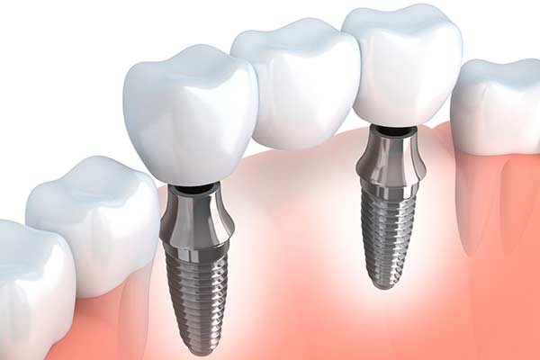 Graphic Showing Dental Implant Supported Bridge