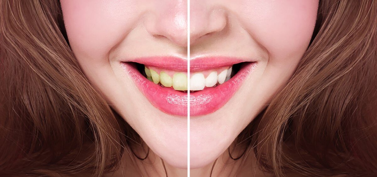 How Porcelain Veneers Can Improve Your Smile Bella Dental NJ