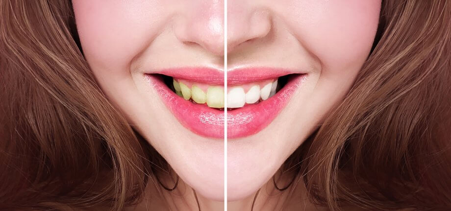 How Porcelain Veneers Can Improve Your Smile