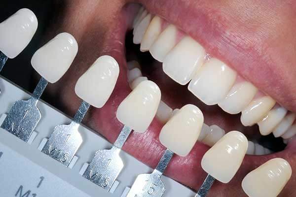 Tooth Shade Guide For Composite Fillings